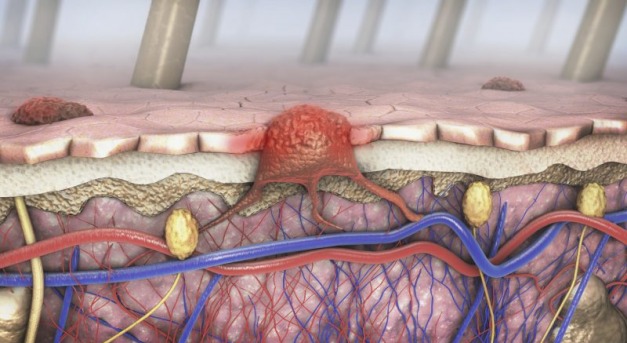 Áttörést hozhat a bőrrák kezelésében magyar szakértők kutatása